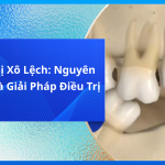 Răng Bị Xô Lệch: Nguyên Nhân Và Giải Pháp Điều Trị