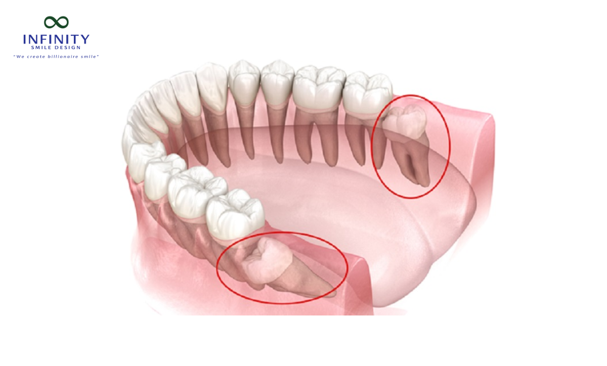 Điều trị răng nanh mọc ngầm như thế nào?