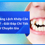 Niềng Răng Lệch Khớp Cắn Bao Lâu? - Giải Đáp Chi Tiết