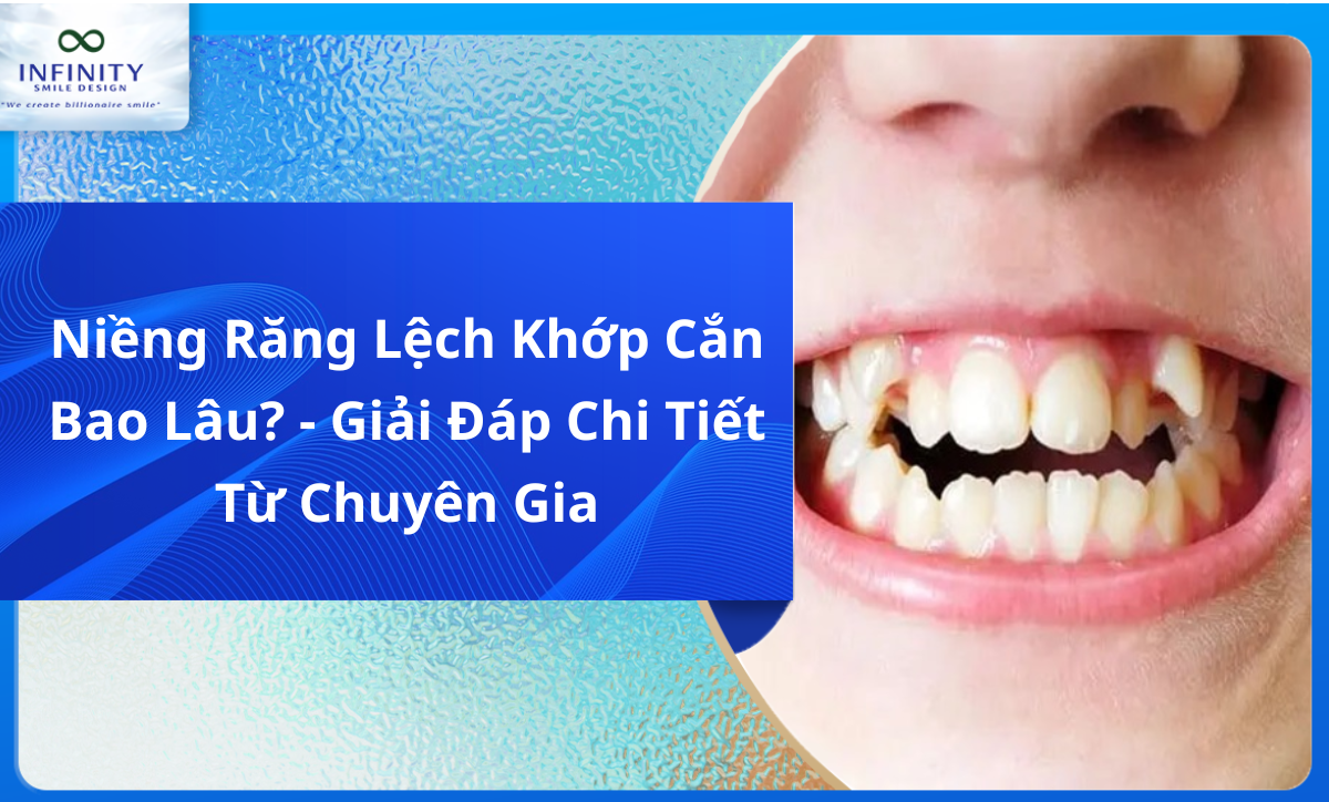 Niềng Răng Lệch Khớp Cắn Bao Lâu? - Giải Đáp Chi Tiết