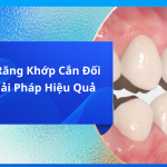 Niềng Răng Khớp Cắn Đối Đầu: Giải Pháp Hiệu Quả