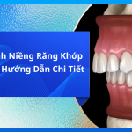 Quy Trình Niềng Răng Khớp Cắn Sâu: Hướng Dẫn Chi Tiết