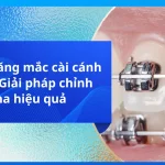Niềng răng mắc cài cánh cam – Giải pháp chỉnh nha hiệu quả