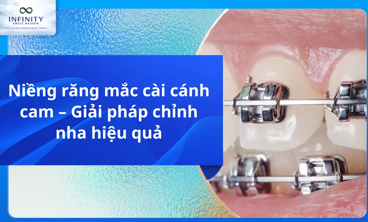 Niềng răng mắc cài cánh cam – Giải pháp chỉnh nha hiệu quả