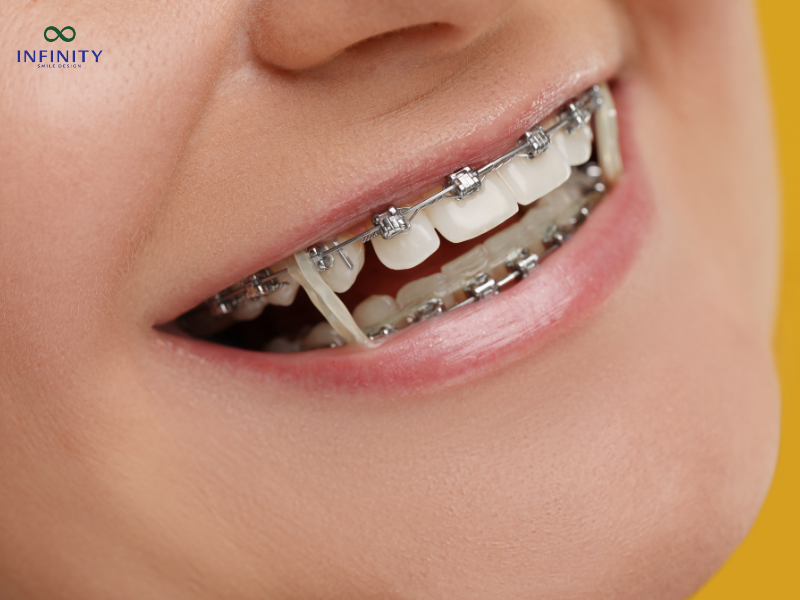 Trong quá trình niềng, lực kéo từ dây cung và mắc cài có thể ảnh hưởng đến răng đã trám