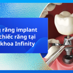 Trồng răng implant một chiếc răng tại Nha khoa Infinity