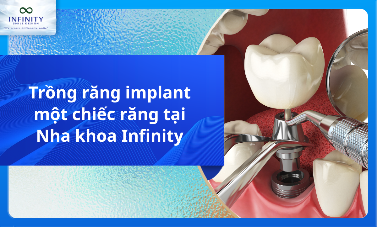 Trồng răng implant một chiếc răng tại Nha khoa Infinity