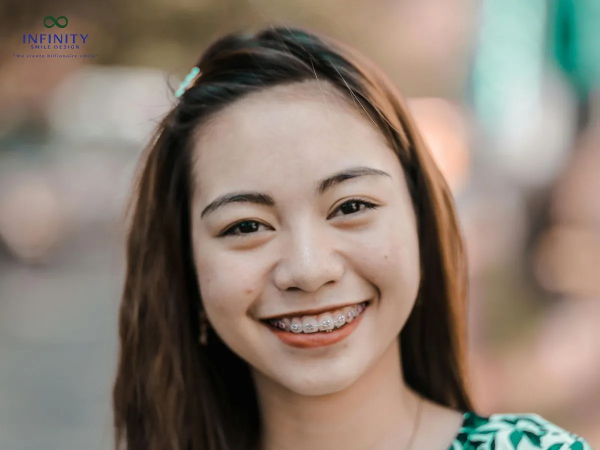 Ảnh hưởng của dây thun niềng răng bị vàng đối với thẩm mỹ và sức khỏe