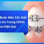 Chỉ Thép Buộc Mắc Cài: Giải Pháp Tối Ưu Trong Chỉnh Nha Hiện Đại