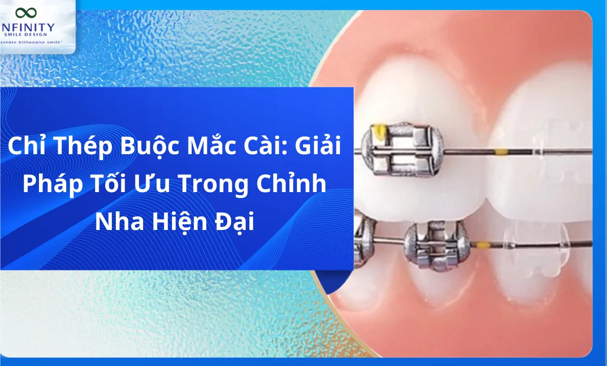 Chỉ Thép Buộc Mắc Cài: Giải Pháp Tối Ưu Trong Chỉnh Nha Hiện Đại