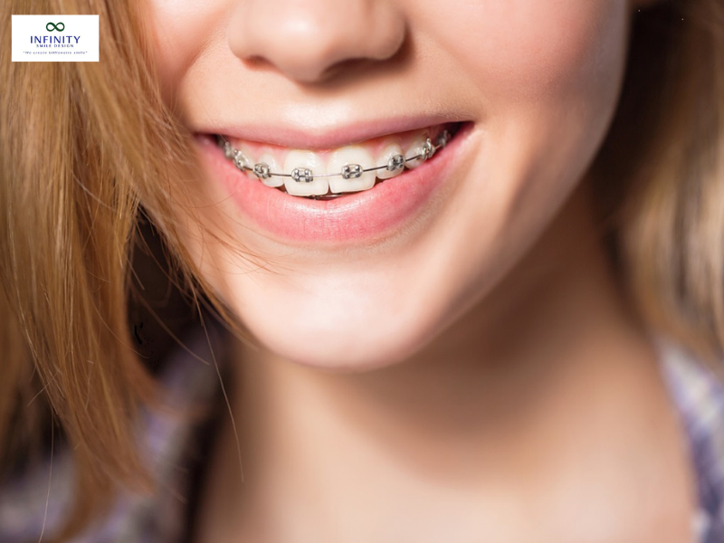 cắm vít niềng răng bị sưng