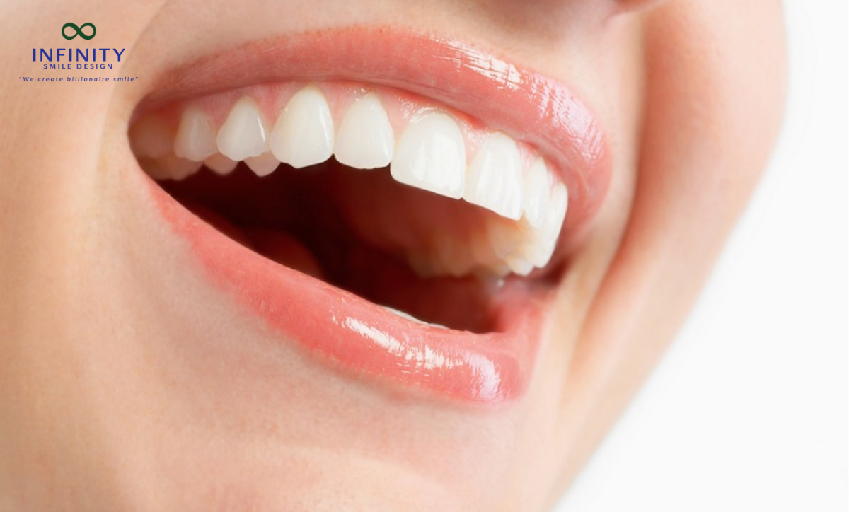 Niềng Răng Thỏ Là Gì?