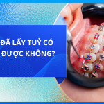 Răng đã lấy tuỷ có niềng được không?