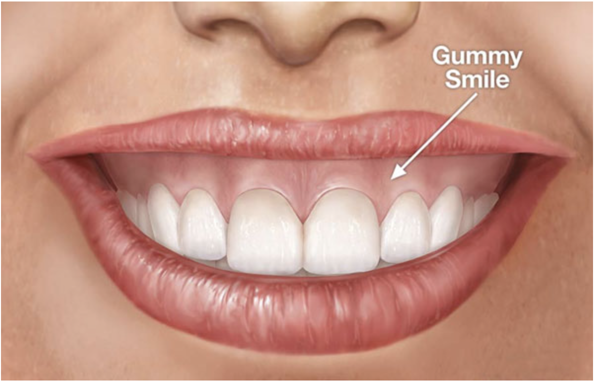Cắt Nướu & Tái Tạo Đường Cười – Điều chỉnh nướu tinh tế, nâng tầm thẩm mỹ 1 Screenshot at May 21 14 32 54