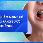 Xương hàm mỏng có niềng răng được không?