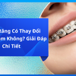 Niềng Răng Có Thay Đổi Xương Hàm Không? Giải Đáp Chi Tiết