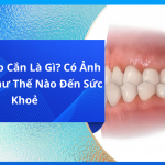 Lệch khớp cắn là gì? Tìm hiểu nguyên nhân