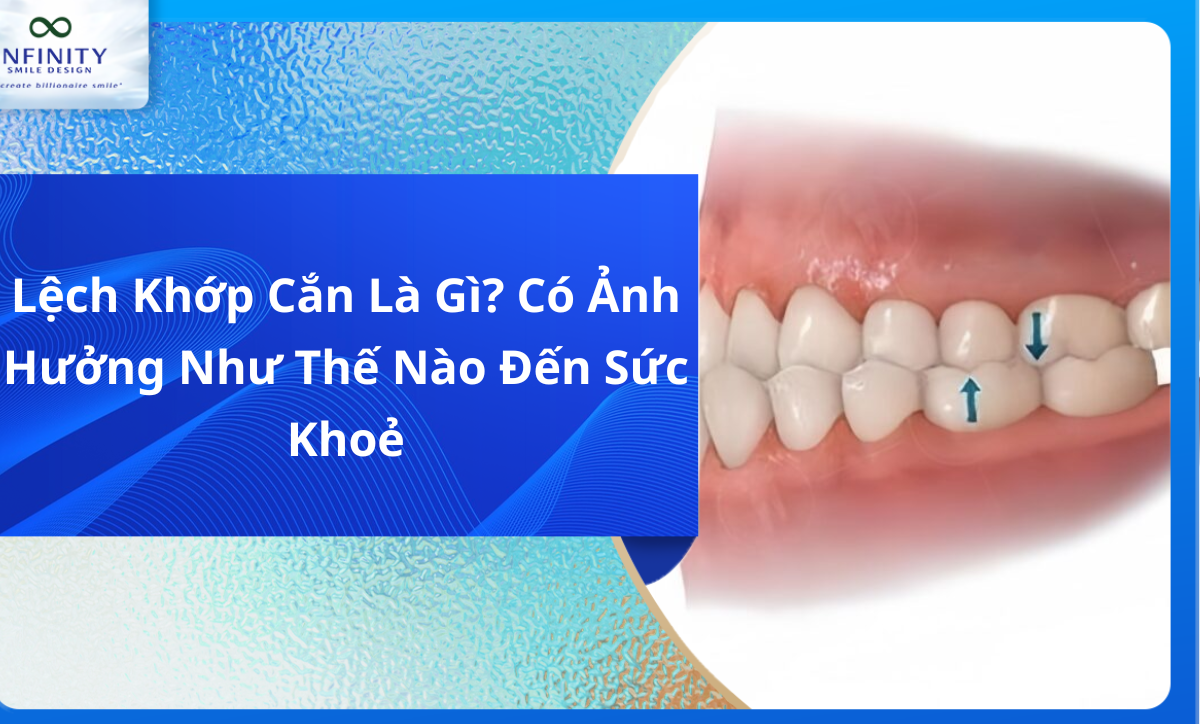 Lệch khớp cắn là gì? Tìm hiểu nguyên nhân
