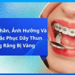 Nguyên Nhân, Ảnh Hưởng Và Cách Khắc Phục Dây Thun Niềng Răng Bị Vàng