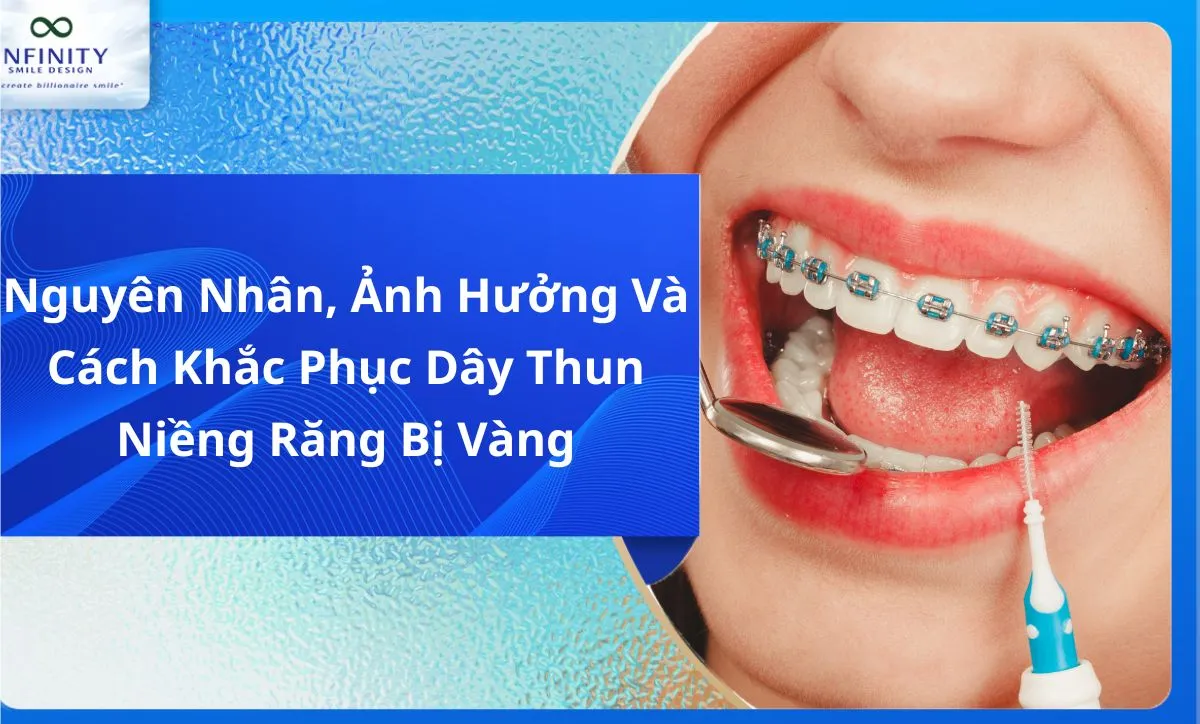 Nguyên Nhân, Ảnh Hưởng Và Cách Khắc Phục Dây Thun Niềng Răng Bị Vàng