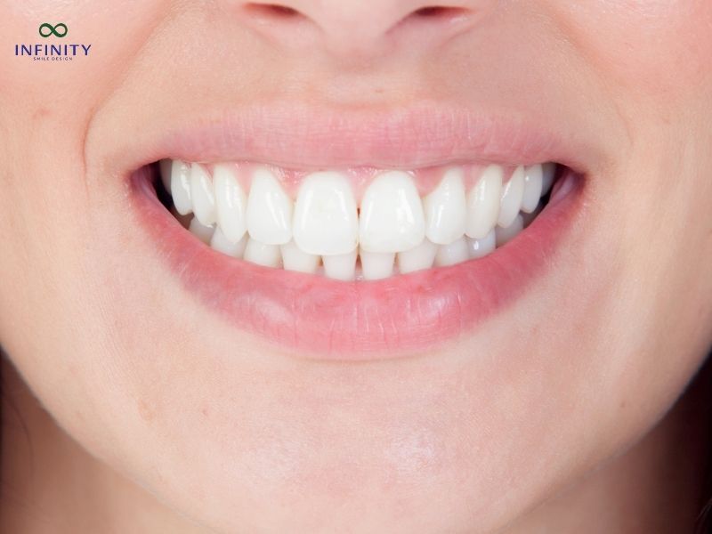 5 Dòng răng sứ phục hình răng sứ cao cấp được ưa chuộng hiện nay