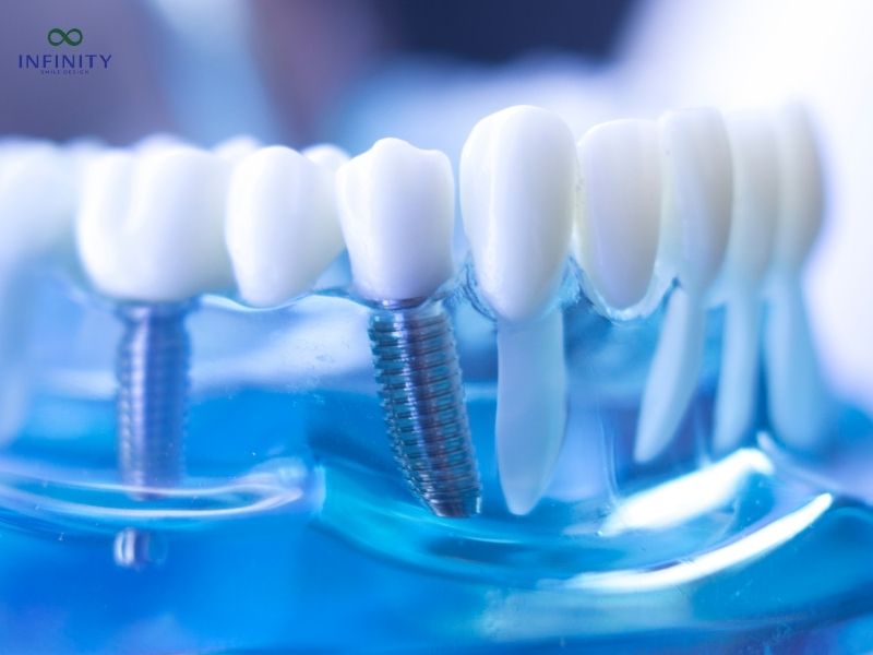 Review thực tế 7 kinh nghiệm đi trồng răng Implant