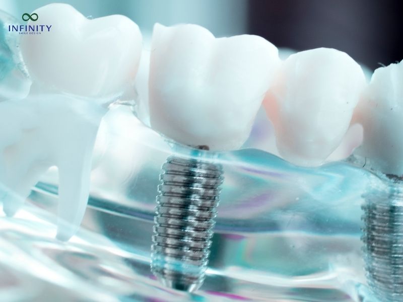 Nên trồng răng bằng cầu răng hay cấy ghép implant?
