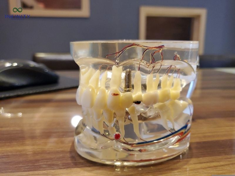 Review thực tế 7 kinh nghiệm đi trồng răng Implant