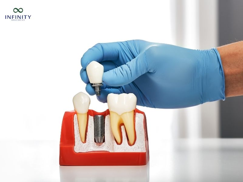 Cấy ghép Implant