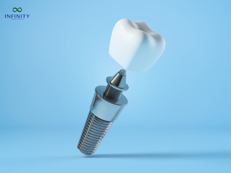 Giá trồng răng implant