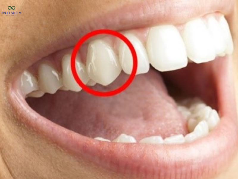 Vị trí chiếc răng số 3 