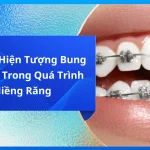 Giải Mã Hiện Tượng Bung Mắc Cài Trong Quá Trình Niềng Răng