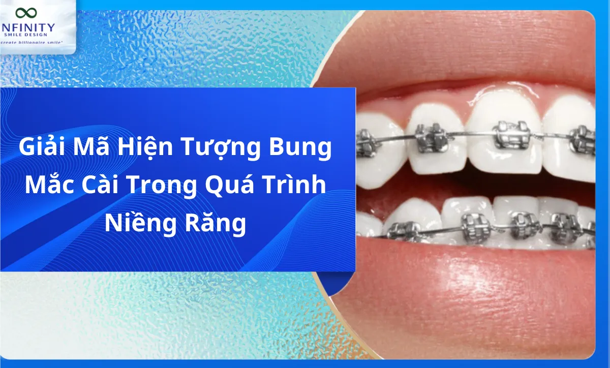 Giải Mã Hiện Tượng Bung Mắc Cài Trong Quá Trình Niềng Răng