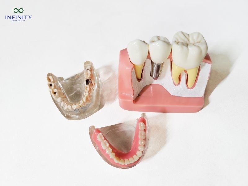 Lựa chọn nha khoa uy tín để tránh hối hận khi trồng Implant giá rẻ Lựa chọn nha khoa uy tín để tránh hối hận khi trồng Implant giá rẻ
