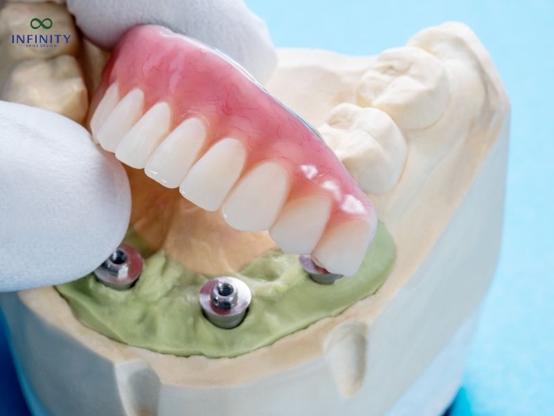 Lưu ý gì khi thực hiện trồng răng Implant?