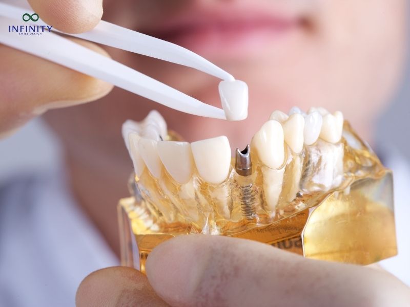 Hậu quả nghiêm trọng vì trồng Implant giá rẻ Hậu quả nghiêm trọng vì trồng Implant giá rẻ