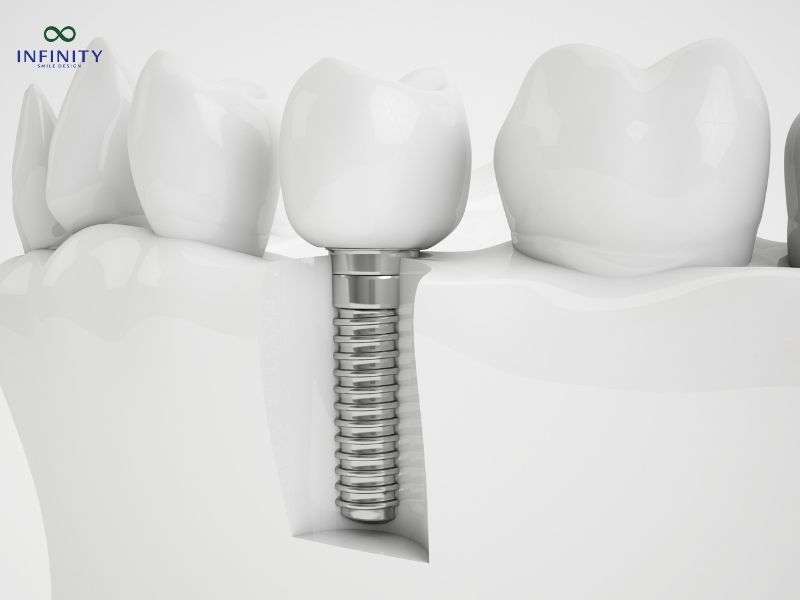 Các tiêu chí lựa chọn địa chỉ nha khoa cấy ghép Implant uy tín