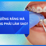 ĐANG NIỀNG RĂNG MÀ MỌC RĂNG PHẢI LÀM SAO?