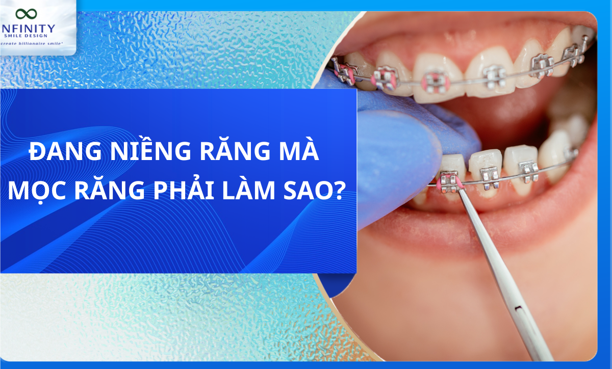 ĐANG NIỀNG RĂNG MÀ MỌC RĂNG PHẢI LÀM SAO?