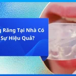 Bộ Niềng Răng Tại Nhà Có Thực Sự Hiệu Quả?