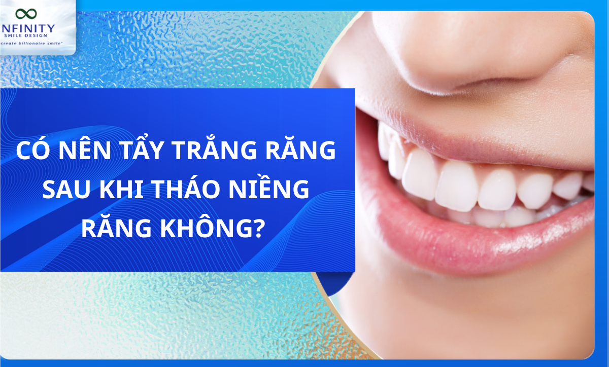 Có nên tẩy trắng răng sau tháo niềng răng