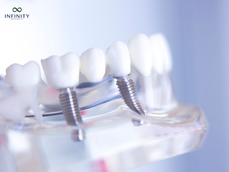 Ưu điểm của trồng răng Implant All on 4