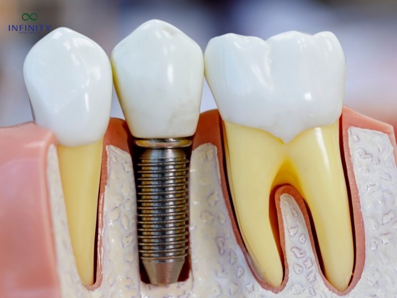 Một số biến chứng muộn của điều trị implant Một số biến chứng muộn của điều trị implant