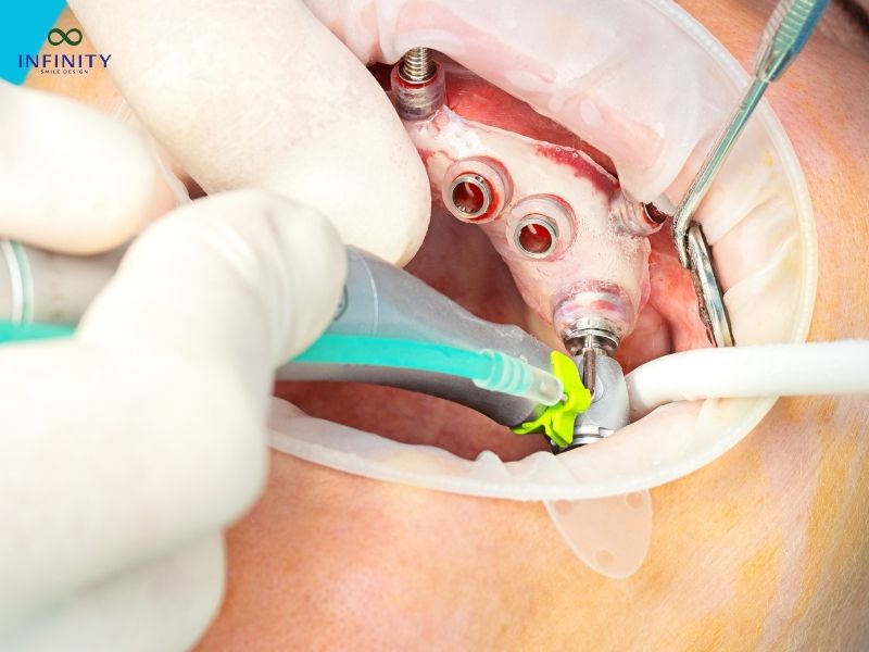 Lưu ý sau khi cấy ghép implant