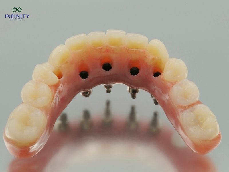 Trồng răng implant nguyên hàm giá bao nhiêu tiền?