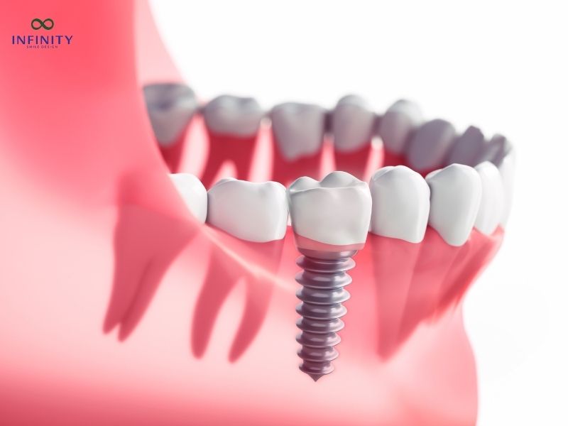 Lưu ý sau khi cấy ghép implant