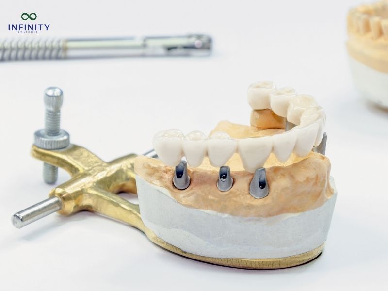 Các phương pháp trồng răng giả nguyên hàm