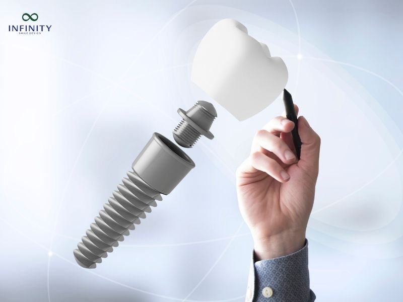 Giá trồng răng Implant All on 4 2025 bao nhiêu?