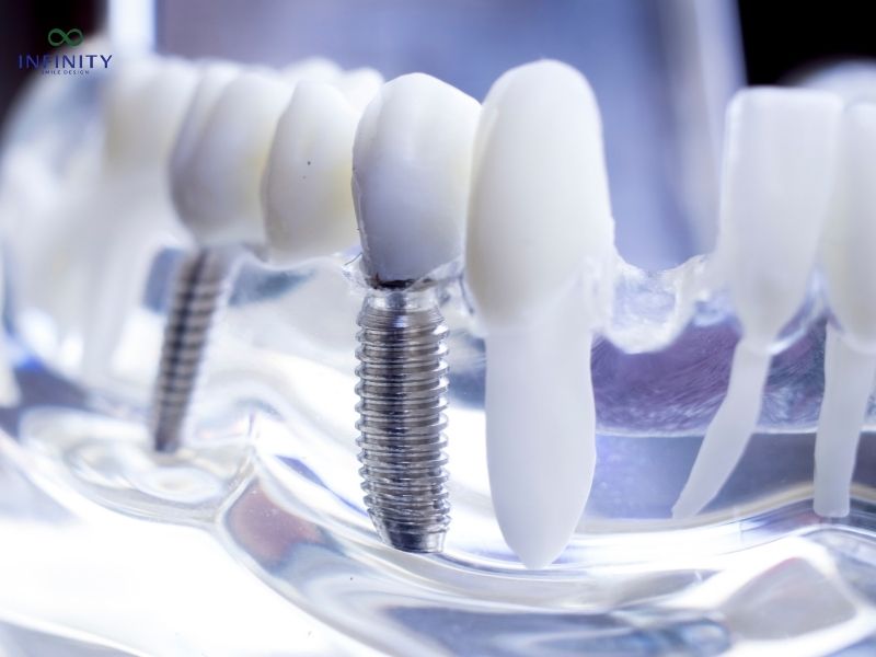 Chăm sóc sau khi trồng răng Implant All on 4