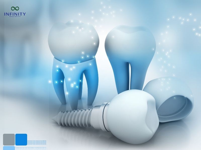 Đối tượng nên thực hiện trồng răng Implant